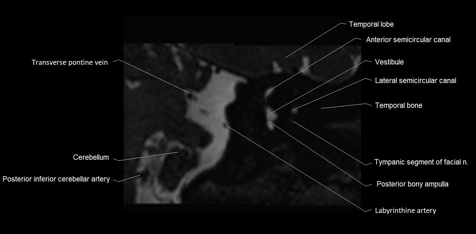 MRI Internal auditory meatus (IAM) coronal cross sectional labelled anatomy image 23.webp